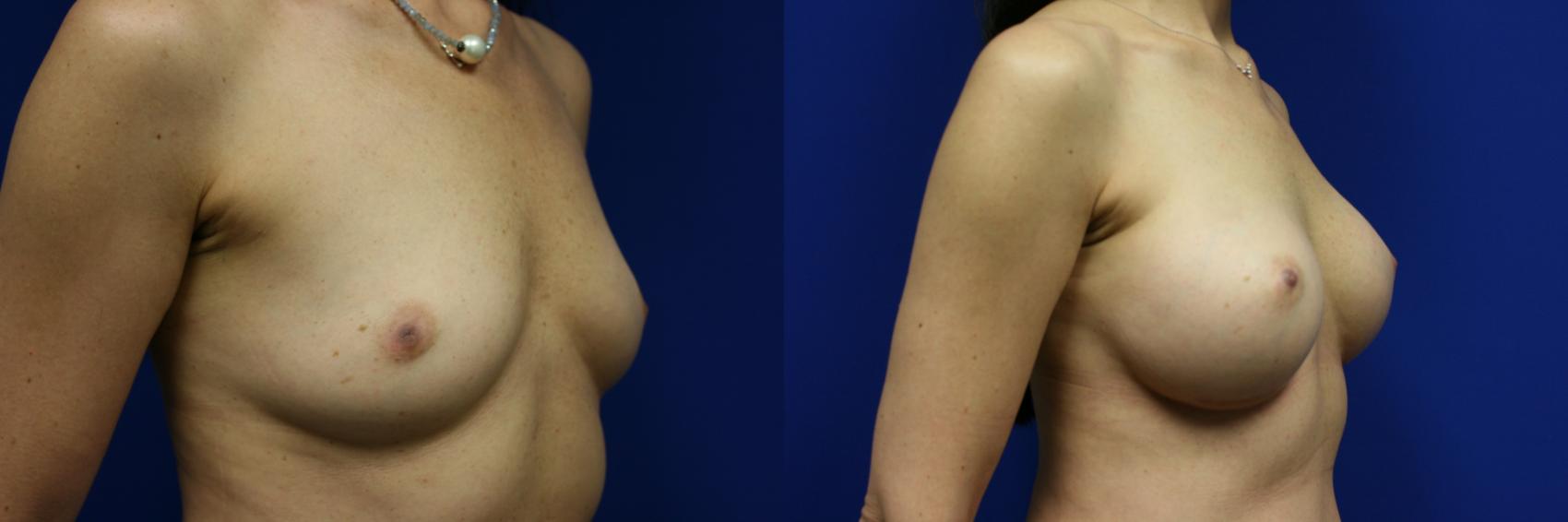 Breast Augmentation Case 103 Before & After Right Oblique | Downers Grove, IL | Dr. Sandeep Jejurikar