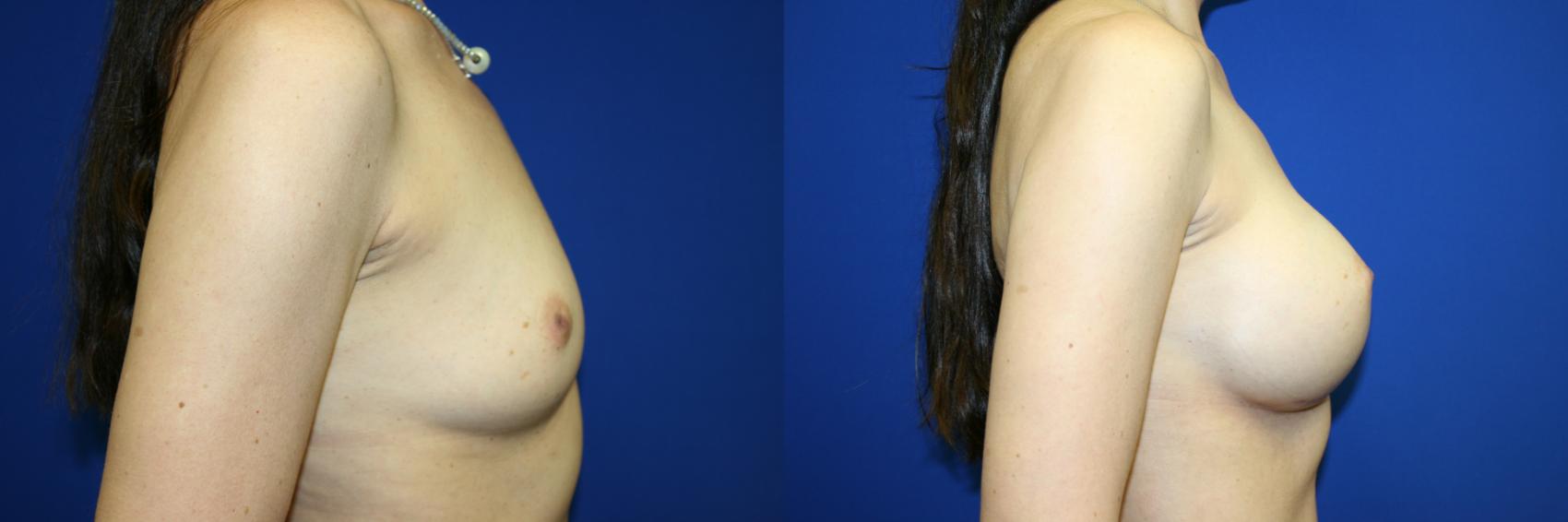 Breast Augmentation Case 103 Before & After Right Side | Downers Grove, IL | Dr. Sandeep Jejurikar