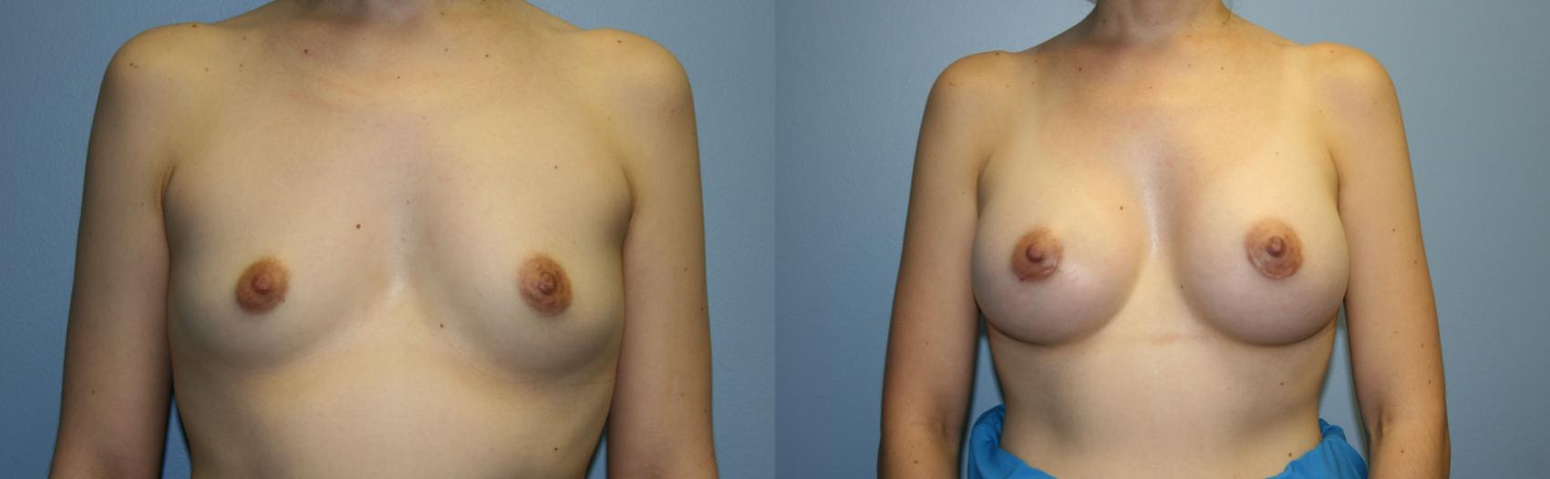Breast Augmentation Case 33 Before & After View #1 | Downers Grove, IL | Dr. Sandeep Jejurikar