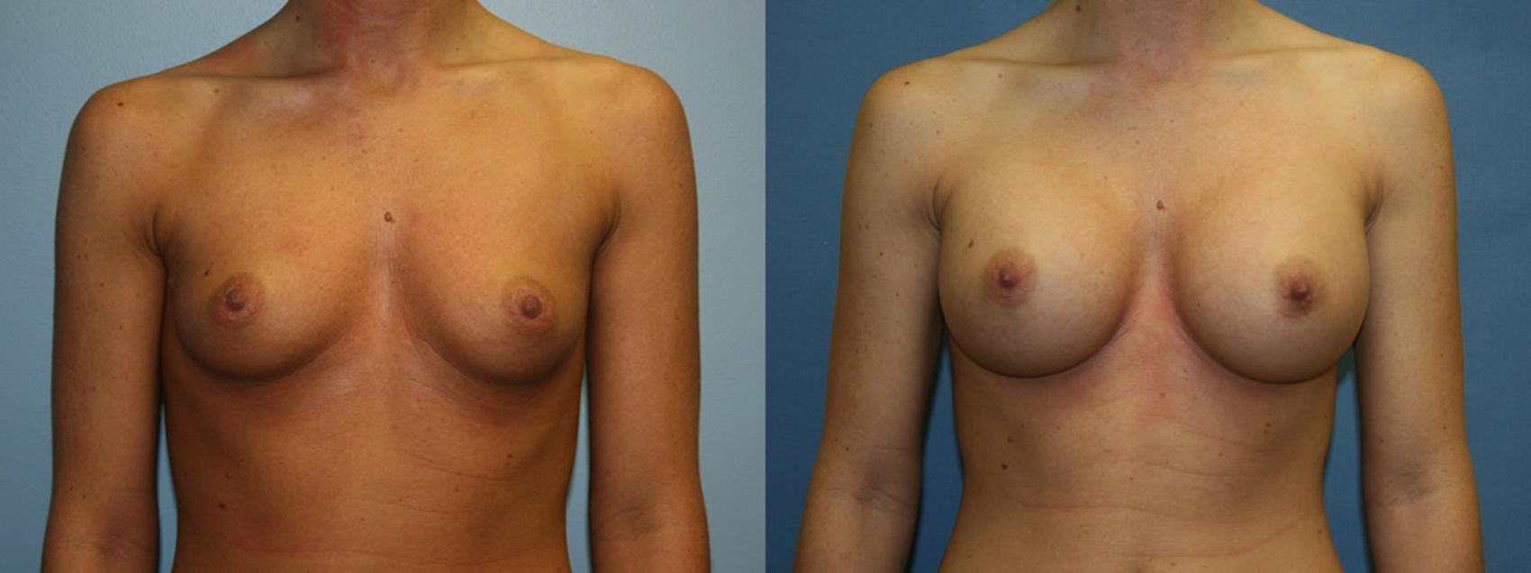 Breast Augmentation Case 4 Before & After View #1 | Downers Grove, IL | Dr. Sandeep Jejurikar