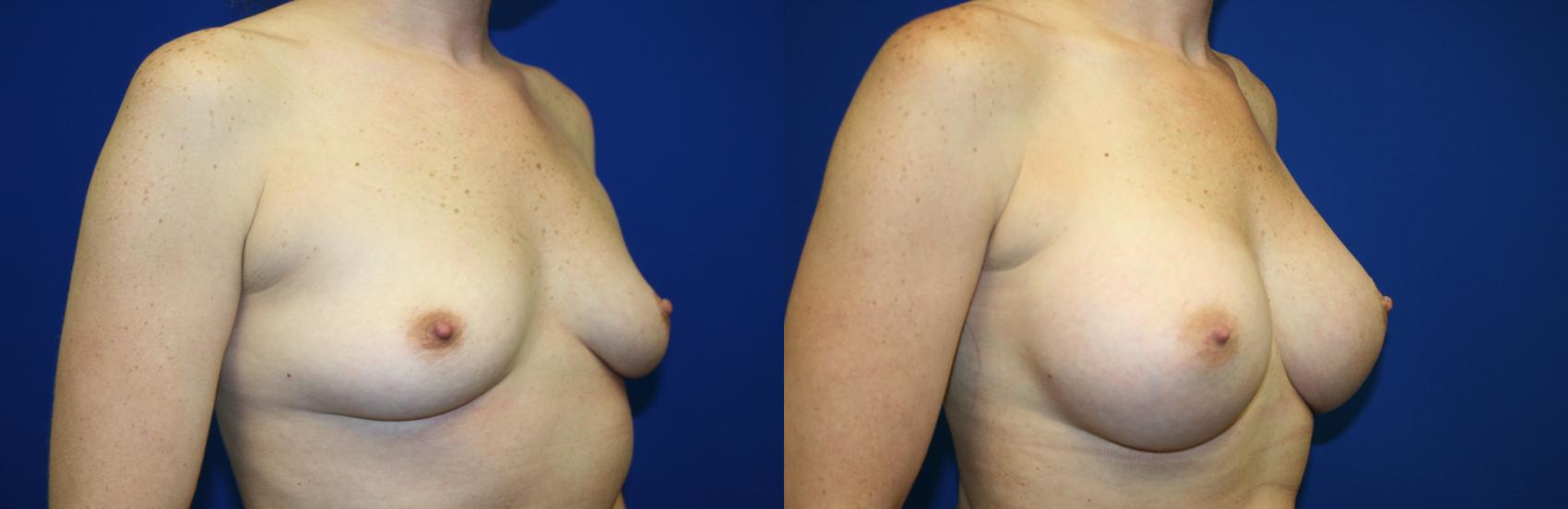 Breast Augmentation Case 94 Before & After Right Oblique | Downers Grove, IL | Dr. Sandeep Jejurikar