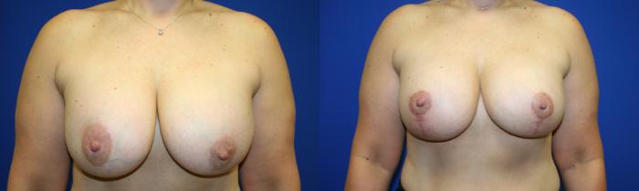 Breast Augmentation Case 75 Before & After Front | Downers Grove, IL | Dr. Sandeep Jejurikar