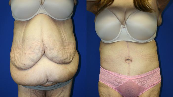 Tummy Tuck Case 138 Before & After Front | Downers Grove, IL | Dr. Sandeep Jejurikar