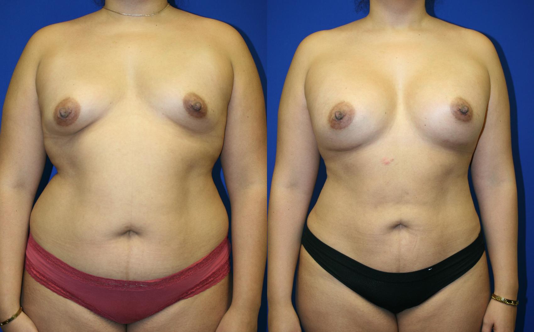 Liposuction Case 66 Before & After Front | Downers Grove, IL | Dr. Sandeep Jejurikar