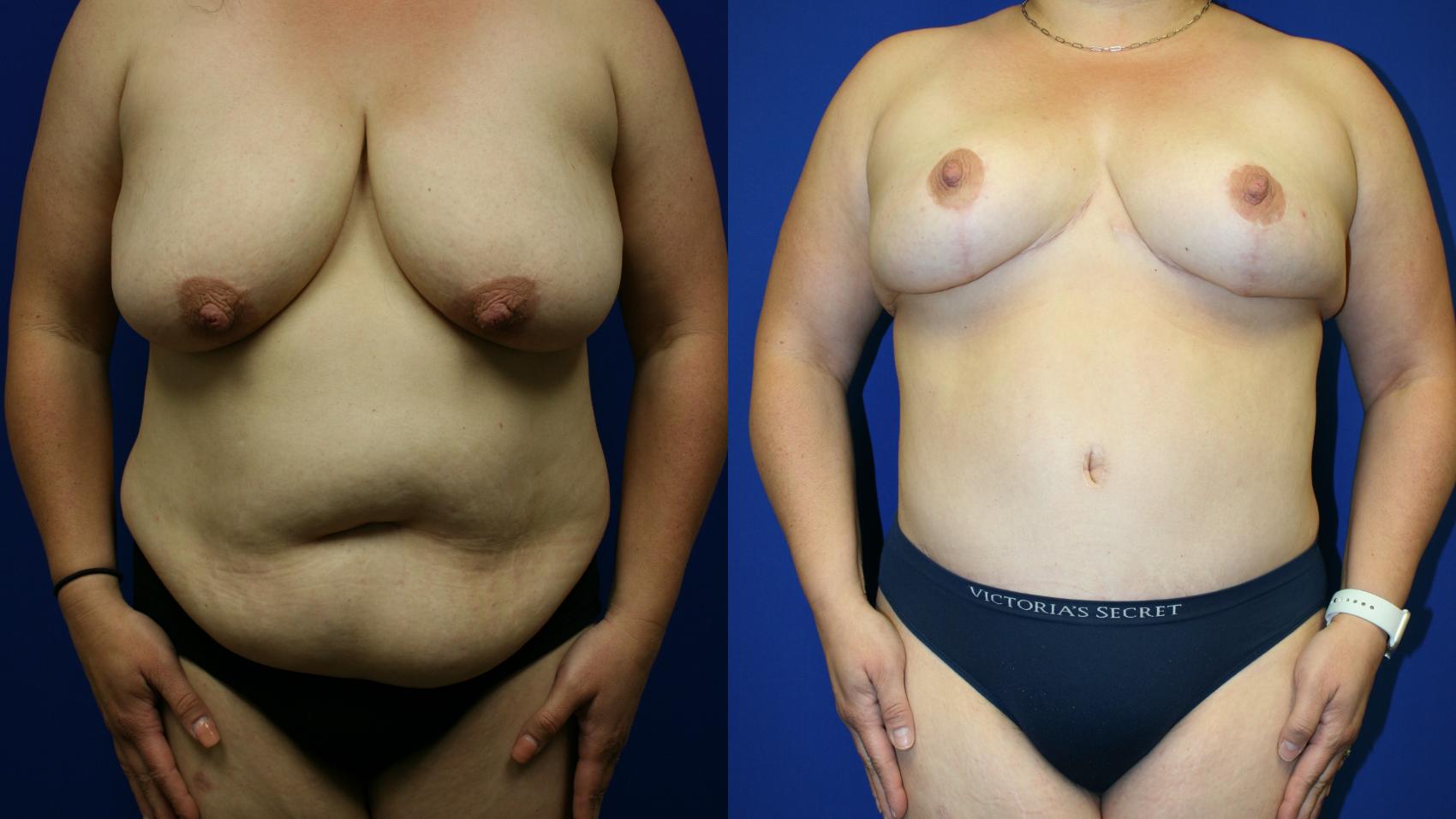 Mommy Makeover Case 136 Before & After Front | Downers Grove, IL | Dr. Sandeep Jejurikar