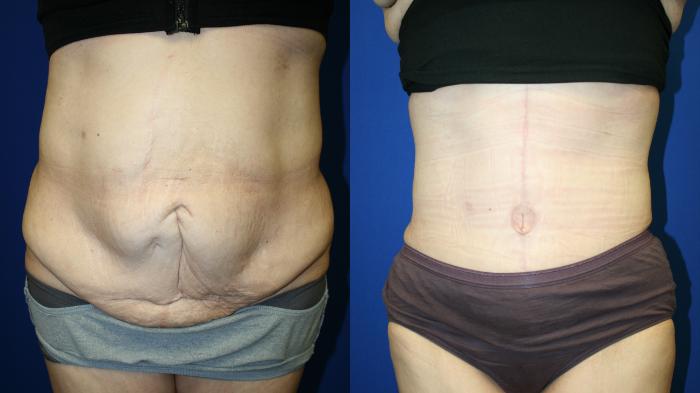 Tummy Tuck Case 139 Before & After Front | Downers Grove, IL | Dr. Sandeep Jejurikar