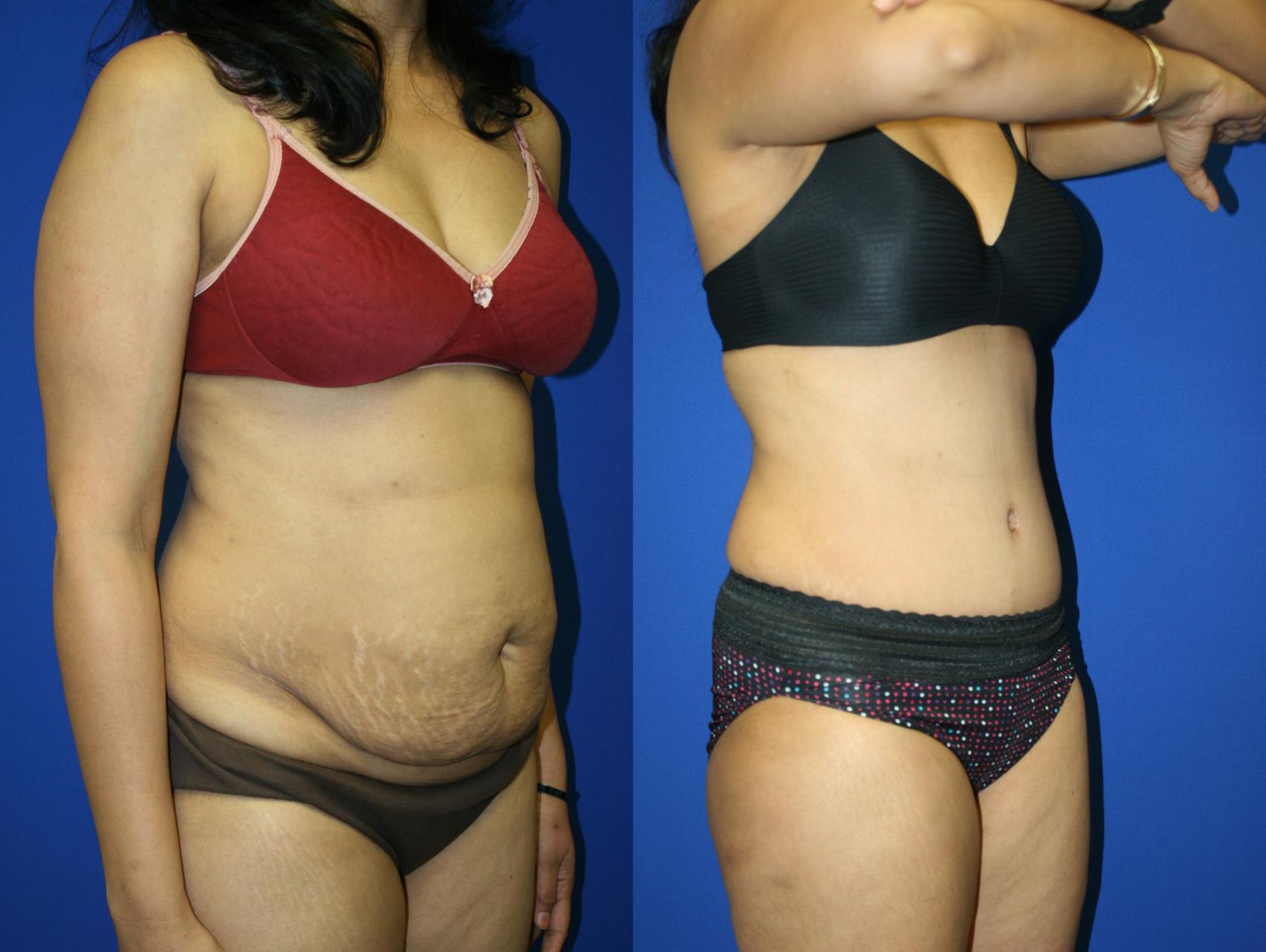 Tummy Tuck Case 69 Before & After Right Oblique | Downers Grove, IL | Dr. Sandeep Jejurikar