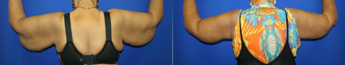 Arm Lift Case 116 Before & After Back | Downers Grove, IL | Dr. Sandeep Jejurikar