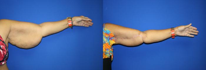 Arm Lift Case 116 Before & After Left Side | Downers Grove, IL | Dr. Sandeep Jejurikar