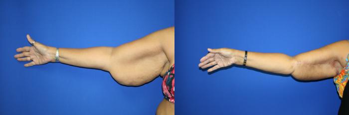 Arm Lift Case 116 Before & After Right Side | Downers Grove, IL | Dr. Sandeep Jejurikar