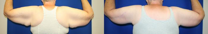 Arm Lift Case 123 Before & After Back | Downers Grove, IL | Dr. Sandeep Jejurikar