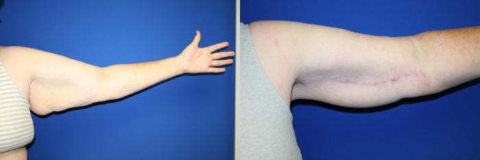 Arm Lift Case 123 Before & After Left Side | Downers Grove, IL | Dr. Sandeep Jejurikar