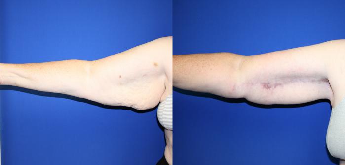 Arm Lift Case 123 Before & After Right Side | Downers Grove, IL | Dr. Sandeep Jejurikar