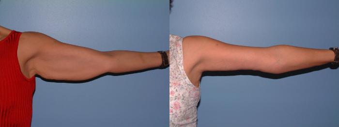 Arm Lift Case 3 Before & After View #1 | Downers Grove, IL | Dr. Sandeep Jejurikar