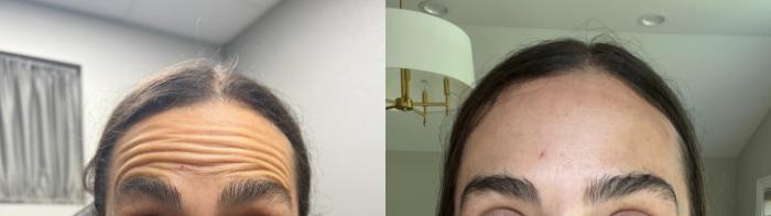 Botox  Case 65 Before & After Front | Downers Grove, IL | Dr. Sandeep Jejurikar