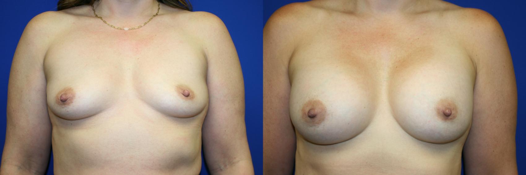 Breast Augmentation Case 102 Before & After Front | Downers Grove, IL | Dr. Sandeep Jejurikar