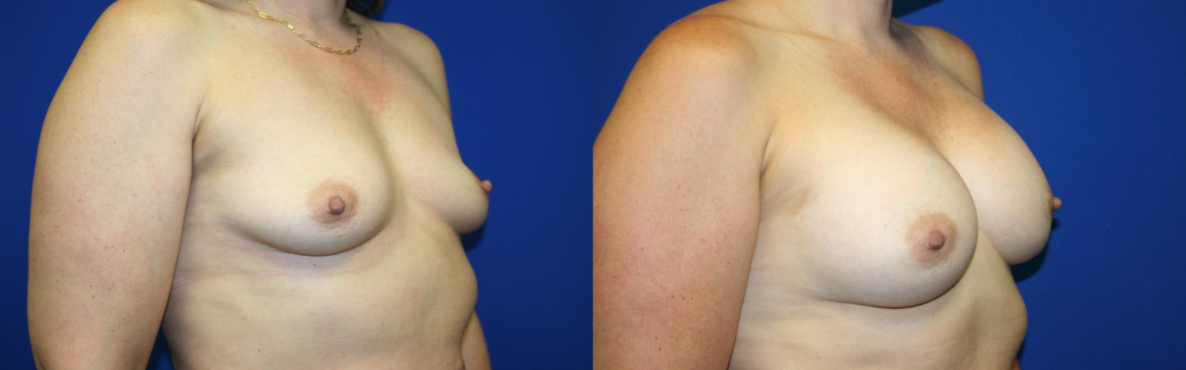Breast Augmentation Case 102 Before & After Right Oblique | Downers Grove, IL | Dr. Sandeep Jejurikar