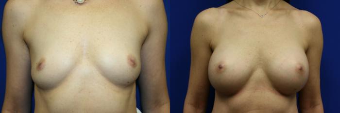 Breast Augmentation Case 103 Before & After Front | Downers Grove, IL | Dr. Sandeep Jejurikar
