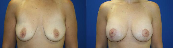 Breast Lift Case 117 Before & After Front | Downers Grove, IL | Dr. Sandeep Jejurikar