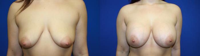 Breast Augmentation Case 121 Before & After Front | Downers Grove, IL | Dr. Sandeep Jejurikar