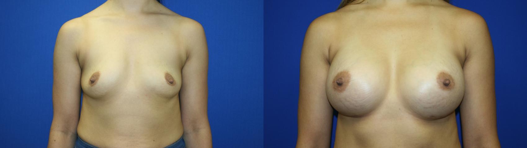 Breast Augmentation Case 129 Before & After Front | Downers Grove, IL | Dr. Sandeep Jejurikar