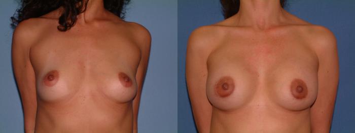 Breast Augmentation Case 16 Before & After View #1 | Downers Grove, IL | Dr. Sandeep Jejurikar