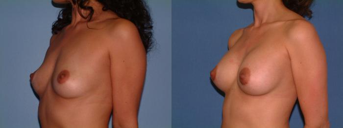 Breast Augmentation Case 16 Before & After View #2 | Downers Grove, IL | Dr. Sandeep Jejurikar