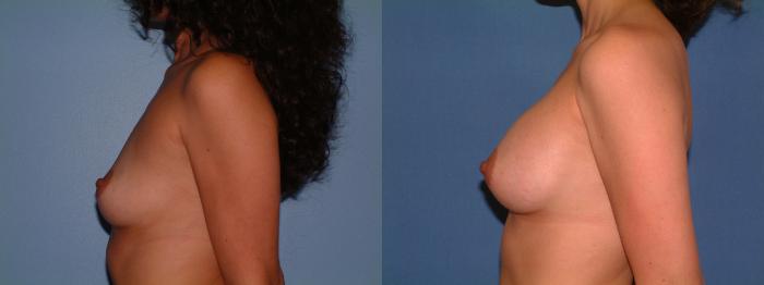 Breast Augmentation Case 16 Before & After View #3 | Downers Grove, IL | Dr. Sandeep Jejurikar