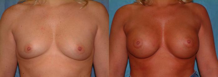 Breast Augmentation Case 22 Before & After View #1 | Downers Grove, IL | Dr. Sandeep Jejurikar