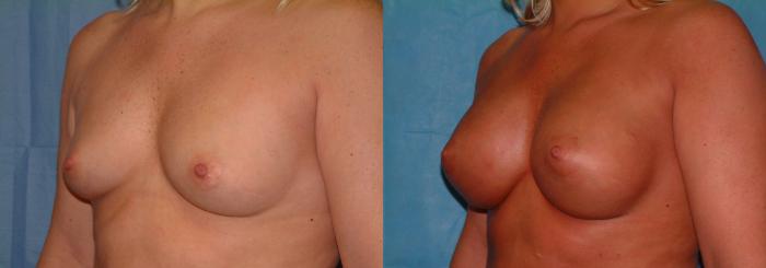 Breast Augmentation Case 22 Before & After View #2 | Downers Grove, IL | Dr. Sandeep Jejurikar