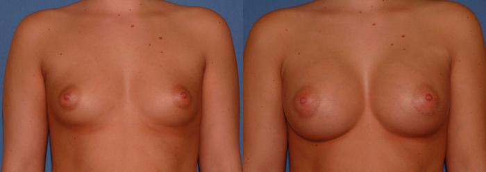 Breast Augmentation Case 28 Before & After View #1 | Downers Grove, IL | Dr. Sandeep Jejurikar