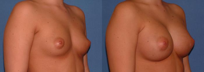 Breast Augmentation Case 28 Before & After View #2 | Downers Grove, IL | Dr. Sandeep Jejurikar