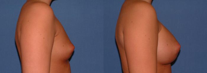 Breast Augmentation Case 28 Before & After View #3 | Downers Grove, IL | Dr. Sandeep Jejurikar