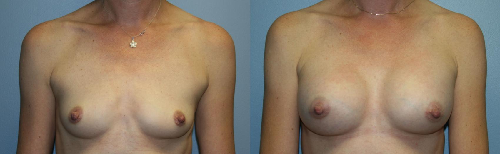 Breast Augmentation Case 31 Before & After View #1 | Downers Grove, IL | Dr. Sandeep Jejurikar