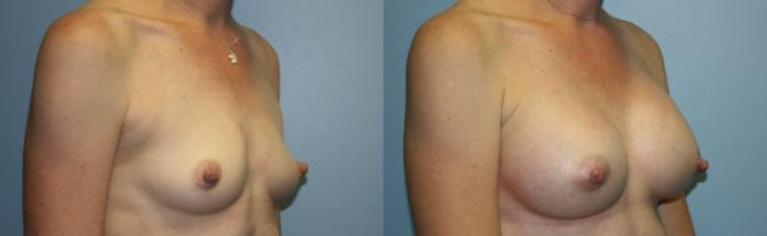 Breast Augmentation Case 31 Before & After View #2 | Downers Grove, IL | Dr. Sandeep Jejurikar