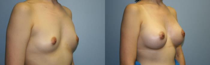Breast Augmentation Case 33 Before & After View #2 | Downers Grove, IL | Dr. Sandeep Jejurikar