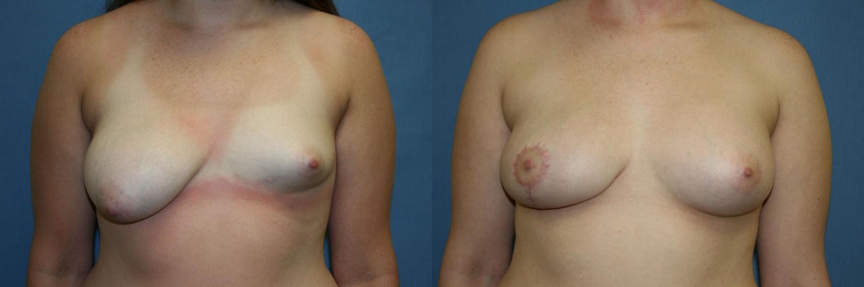 Breast Augmentation Case 35 Before & After View #1 | Downers Grove, IL | Dr. Sandeep Jejurikar