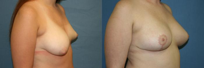 Breast Augmentation Case 35 Before & After View #2 | Downers Grove, IL | Dr. Sandeep Jejurikar