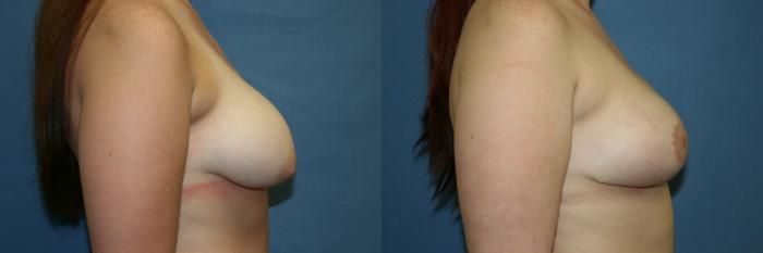 Breast Augmentation Case 35 Before & After View #3 | Downers Grove, IL | Dr. Sandeep Jejurikar