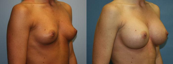 Breast Augmentation Case 4 Before & After View #2 | Downers Grove, IL | Dr. Sandeep Jejurikar