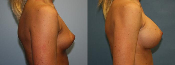 Breast Augmentation Case 4 Before & After View #3 | Downers Grove, IL | Dr. Sandeep Jejurikar