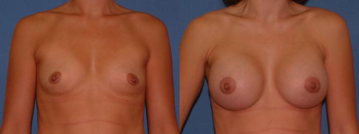 Breast Augmentation Case 5 Before & After View #1 | Downers Grove, IL | Dr. Sandeep Jejurikar