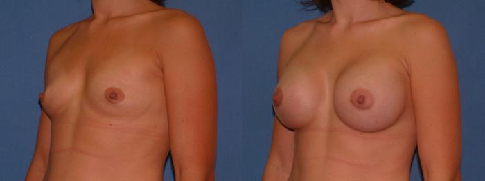 Breast Augmentation Case 5 Before & After View #2 | Downers Grove, IL | Dr. Sandeep Jejurikar