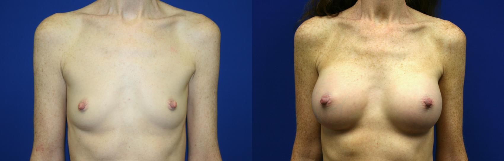 Breast Augmentation Case 57 Before & After Front | Downers Grove, IL | Dr. Sandeep Jejurikar