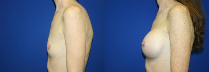 Breast Augmentation Case 57 Before & After Left Side | Downers Grove, IL | Dr. Sandeep Jejurikar