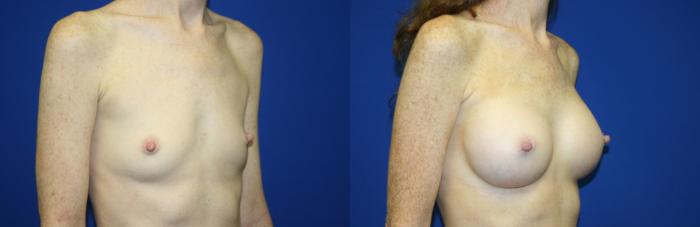 Breast Augmentation Case 57 Before & After Right Oblique | Downers Grove, IL | Dr. Sandeep Jejurikar