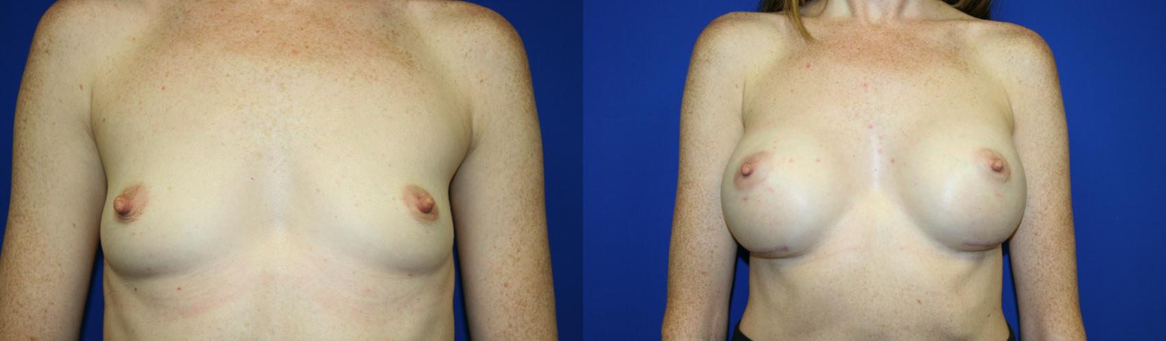 Breast Augmentation Case 63 Before & After Front | Downers Grove, IL | Dr. Sandeep Jejurikar