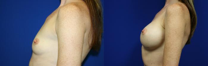 Breast Augmentation Case 63 Before & After Left Side | Downers Grove, IL | Dr. Sandeep Jejurikar