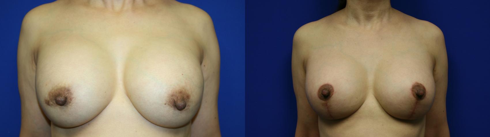 Breast Augmentation Case 74 Before & After Front | Downers Grove, IL | Dr. Sandeep Jejurikar