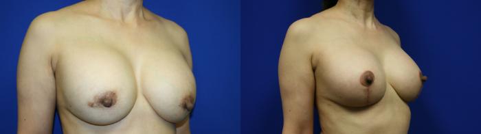 Breast Lift Case 74 Before & After Right Oblique | Downers Grove, IL | Dr. Sandeep Jejurikar